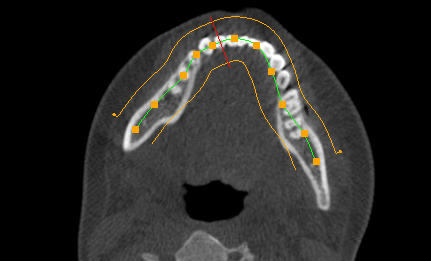 Axial View with Curve and line - reference of sagittal plane